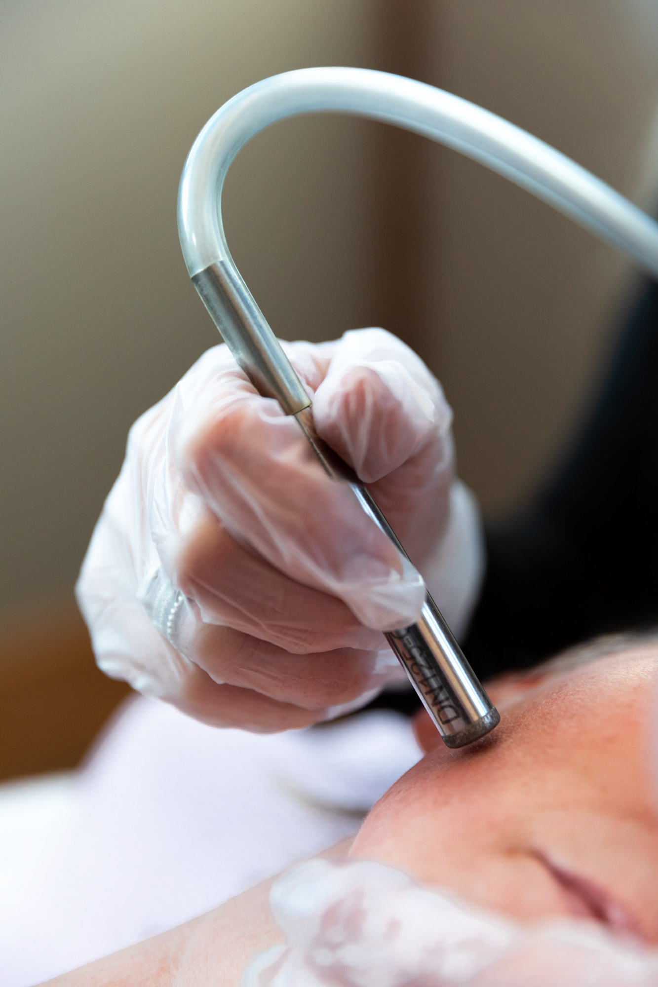 Microdermabrasion in Silverdale Kate Allen Aesthetics